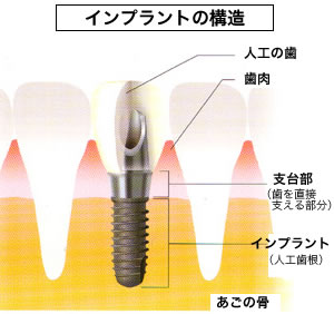 インプラントの構造