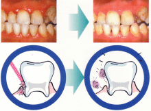 歯周病治療例