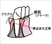 歯周炎