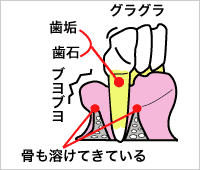 歯周病中程度